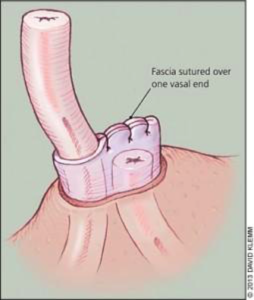 No-Scalpel Vasectomy Doctor - Toronto, Ontario - GTA